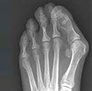 bunion-xray
