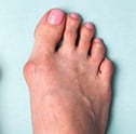bunion