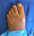 operated-foot