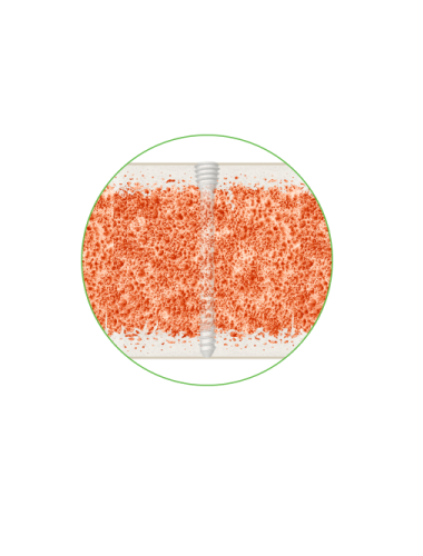 Illustration of ossio screw in bone